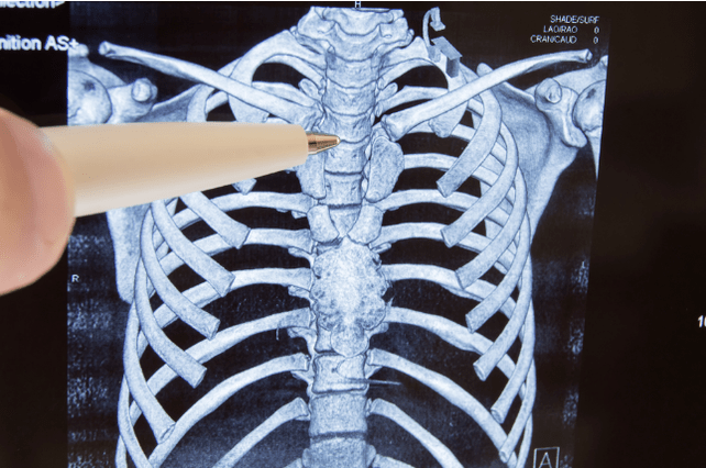Osteochondrosis