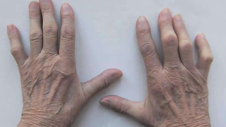 Methods for treating pain in the fingers joints