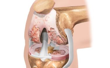 Arthrosis of the knee joint