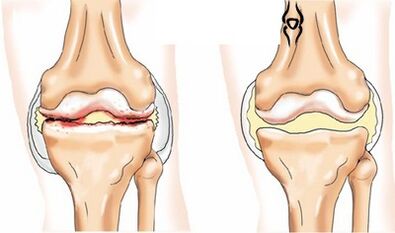 Bilateral gonarthrosis
