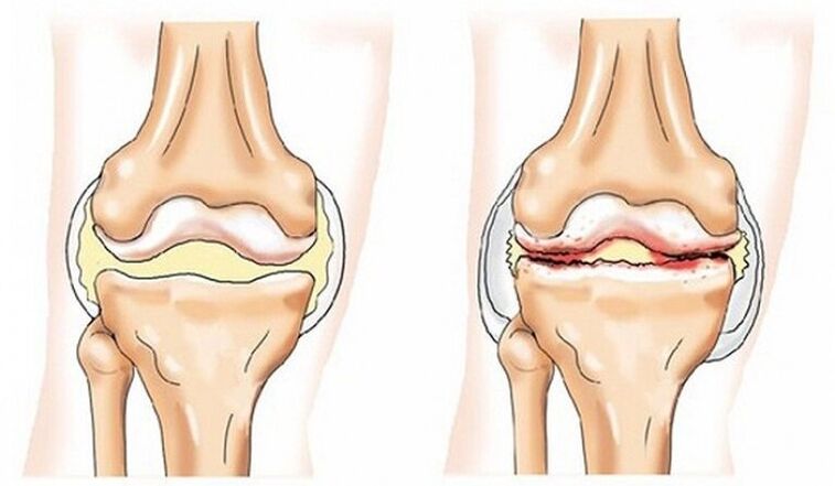 Healthy joints and joints affected by arthrosis