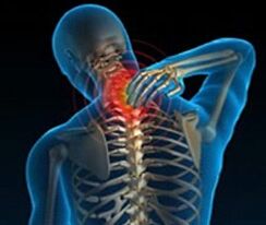 Osteochondrosis of the cervical spine