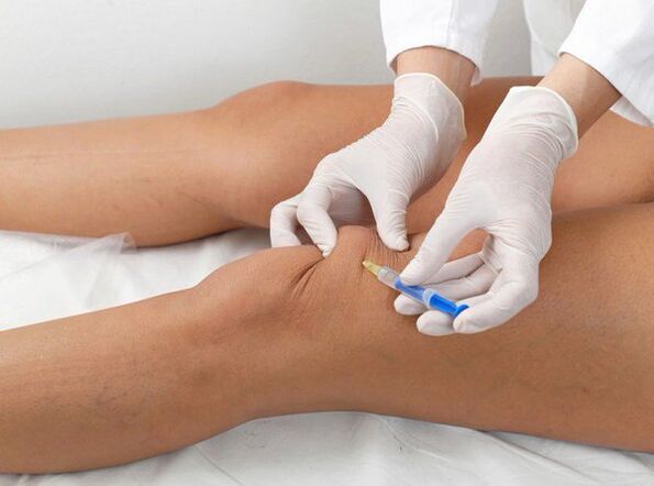 Intra-articular injection for knee osteoarthritis