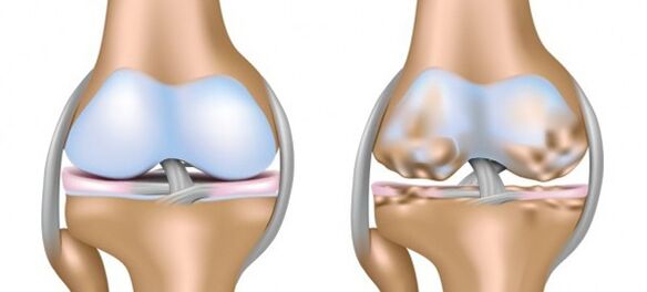 healthy cartilage affected by osteoarthritis