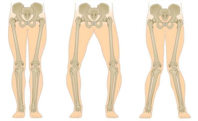 Complications of knee osteoarthritis