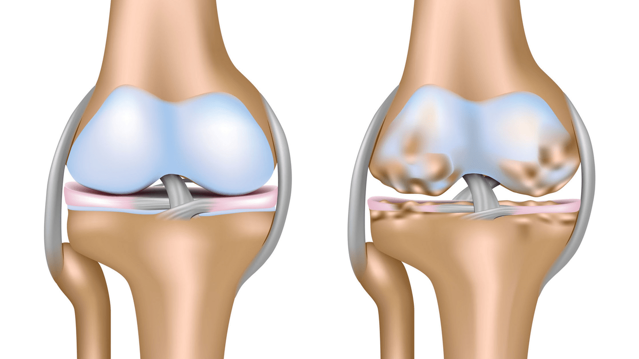 Gonarthrosis of the knee joint
