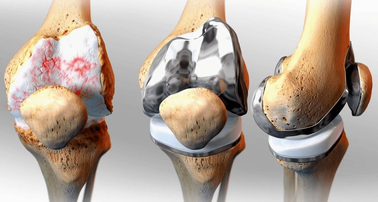 Knee replacement