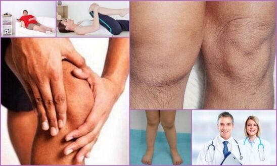 Symptoms of knee osteoarthritis