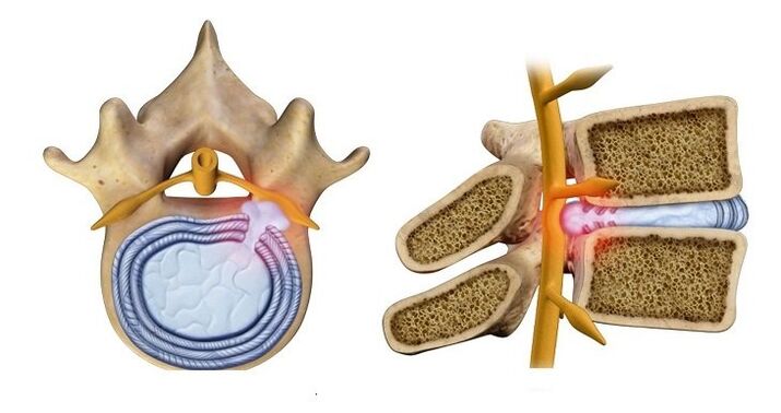 Herniated disc – bulging of the disc nucleus into the spinal canal